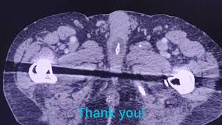 Malposition of Folley catheter  the importance to check   CT findings [upl. by Illona25]