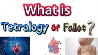 Tetralogy of fallot [upl. by Sid629]