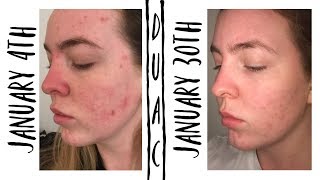 MY ACNE STORY AND HOW DUAC SAVED MY SKIN [upl. by Pages]