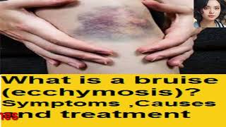 What is a bruise ecchymosis Symptoms  Causes and treatment [upl. by Avrenim]