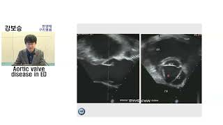 ER과 대동맥 판막 Aortic valve disease in ER  강보승 한양의대 [upl. by Leonidas]