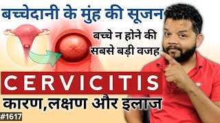 बच्चेदानी के मुख की सूजनकारण और इलाज  Cervicitis  Uterus Infection  Pelvic Pain [upl. by Nryhtak202]