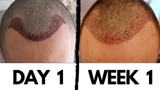 Hair Transplant Results after 1 Week  How to Remove Scabs and Dry Skin of Implanted Area DHI [upl. by Dreeda]