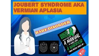 Joubert syndrome  vermian Aplasia  Rare genetic disorder  Molar Tooth 🦷  Case study 🧠 [upl. by Kosiur]