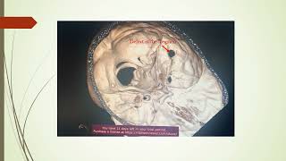 This video shows the defect on the Tegmen with 3D reconstruction of temporal bone [upl. by Ahsemik]