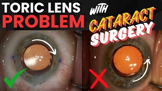 Toric Lens in WRONG Position after Cataract Surgery  What to do [upl. by Kwan]