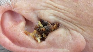 Ear Wax Removal Ear Wax Cleaning [upl. by Hedy631]