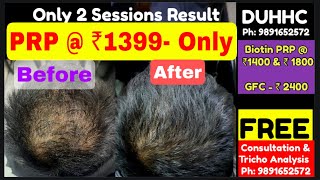 PRP Result with Before amp After Pics PRP  ₹1399 Only Ph 9891652572 PRP Result in Hair Loss [upl. by Allemrac441]