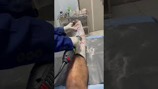 Removing gips after injured automobile fracture [upl. by Nogem748]