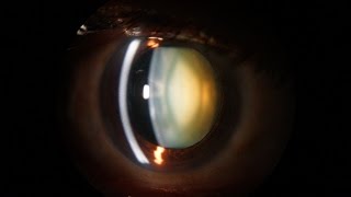 Slit Lamp examination of the anterior segment of the eye [upl. by Gladys]