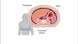 Hemoperitoneum  Definition Causes Symptoms and Treatment [upl. by Libenson139]