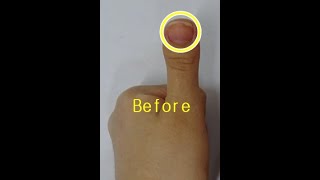 Clubbed thumbs surgery by Dr Ahn [upl. by Lanza]