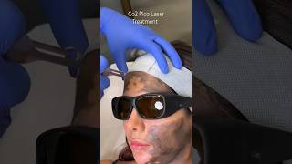 Co2 Pico Laser Treatment at CARA [upl. by Godbeare]