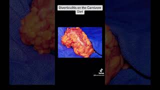 Diverticulitis and Diverticulosis on the Carnivore Diet [upl. by Adham]