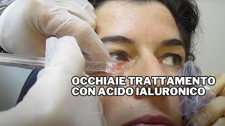 Occhiaie Trattamento con Acido Ialuronico [upl. by Henebry]