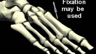 Weil Lesser Metatarsal Osteotomy Severe hammertoe correction procedure [upl. by Nnire]