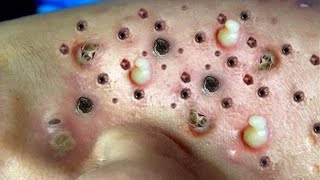 Paid  954 To Remove These Blackheads and Here is What Happened [upl. by Yttam]