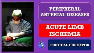 ACUTE LOWER LIMB ISCHEMIA How To DIAGNOSE amp TREAT Peripheral Arterial Diseases [upl. by Ahseyt]