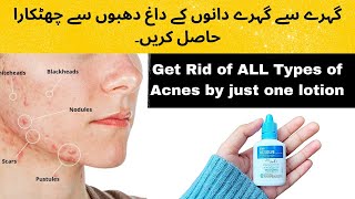 ACSOLVE Lotion for ALL TYPES OF Acnes amp Acne scars  Get rid of all PIMPLES [upl. by Romeon]