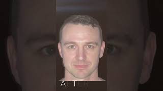 Rhinoplasty Surgery Before amp After Photos Bulbous Tip amp Dorsal Hump nosejobs [upl. by Atiugram]