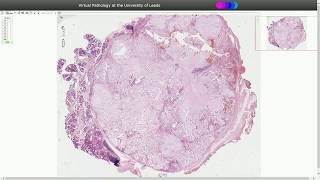 Pleomorphic Adenoma  Histopathology [upl. by Siravrat]