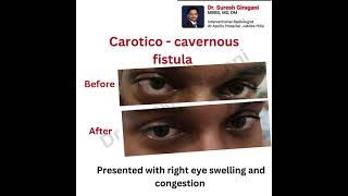 Dr Suresh Giragani Treats Carotid Cavernous Fistula CCF with Advanced Embolization [upl. by Elbon]