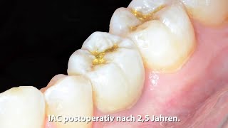 Extraktion und sofortversorgung mit der Intergrierten Abutment Krone IAC [upl. by Fougere]