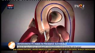 Premieră în România implantare de valvă aortică printro incizie de 5 cm în dreptul inimii [upl. by Ivey249]