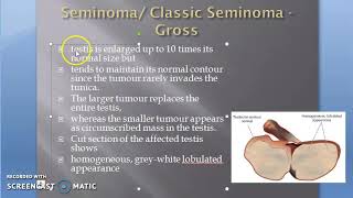 Pathology 711 cd Seminoma testis Gross Tumor cancer [upl. by Porche]