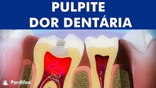 Pulpite  Inflamação da polpa dentária © [upl. by Baillieu]