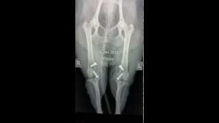 RidgeStop prosthetic trochlear ridge  pre and post op xrays [upl. by Xonnel]