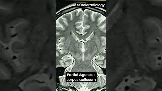 Partial Agenesis Corpus callosum colpocephaly neuroradiology s9teleradiology congenital mri [upl. by Hammel]