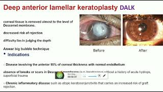 keratoplasty part 2 [upl. by Ennobe306]