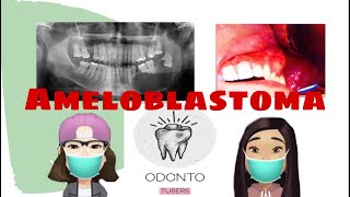 AMELOBLASTOMA TUMOR ODONTÓGENO [upl. by Yentterb307]