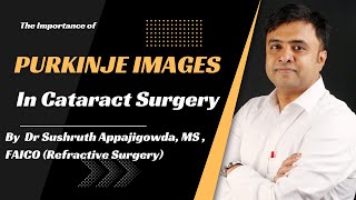 The Importance of Purkinje Images in Cataract Surgery [upl. by Forta770]