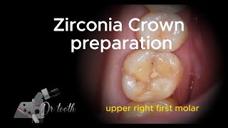 Zirconia crown preparation of upper first molar 상악 대구치 지르코니아 미러뷰 프렙 영상 [upl. by Boonie]