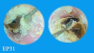 Difficult Furry Ear Wax Plug Removal EP31 earwaxremoval asmr [upl. by Rosabella]