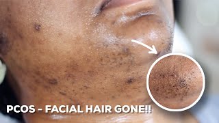 HOW TO WAX YOUR CHIN HAIR AT HOME  DIY Sugar Wax Hair Removal Hack [upl. by Skelly]