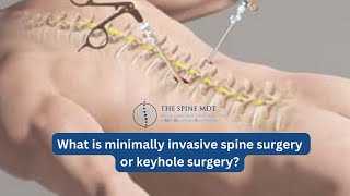 What is minimally invasive spine surgery or keyhole surgery [upl. by Norton]