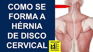 Como se forma a hérnia de disco cervical [upl. by Ieluuk]