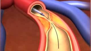 Percutaneous coronary Intervention stenting [upl. by Auhsohey]