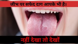 Oral thrush । Leukoplakia। Oral health [upl. by Seif705]