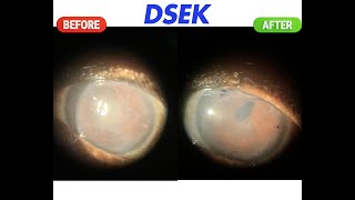 DSEK for bullous keratopathy [upl. by Aspia]