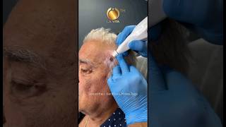 Seborrheic Keratosis Removal wt PLexr Laser [upl. by Lamrert]