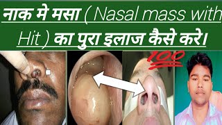 Nasal Polyps नाक मे मसा  Nasal mass with Hit  का पुरा इलाज कैसे करे। Abhia2zmedical [upl. by Wardlaw205]