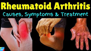 Rheumatoid Arthritis – Signs amp Symptoms Causes Diagnosis Treatment Complications [upl. by Hafital833]