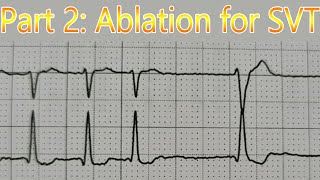 ABLATION for AVNRTSupraventricular Tachycardia SVT and moving on Part 2 [upl. by Becky833]