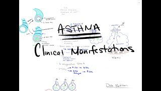 Asthma  Clinical Manifestations [upl. by Rednasela]