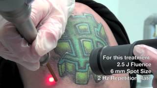 QSwitched Ruby Laser  Astanza Eternity Tattoo Removal Laser [upl. by Eduard]