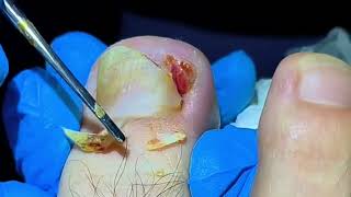 Huge Ingrown Toenail Removal and Treatment [upl. by Adaurd]